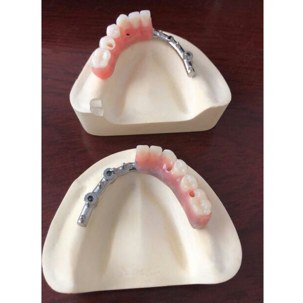 Implant Hybrid Denture